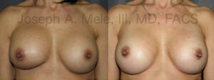 Breast Augmentation Revision Before and After Uncensored
