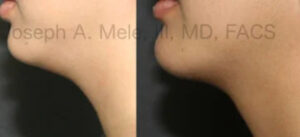 Before and After Chin Augmentation with Chin Implant and Neck Liposuction