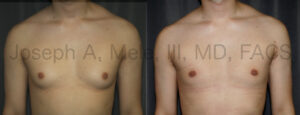 Gynecomastia Reduction Before and After Pictures (Male Breast Reduction)