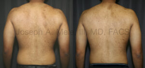 Liposuction of the Back Before and After Pictures (Male Love Handle Reduction)