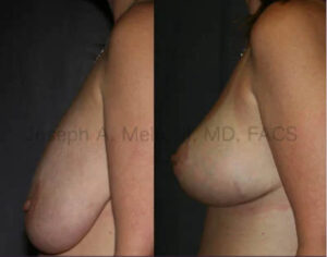 Breast Lift Before and After Pictures (uncensored)