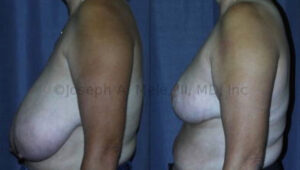 Reduction Mammoplasty for Women - before and after photos
