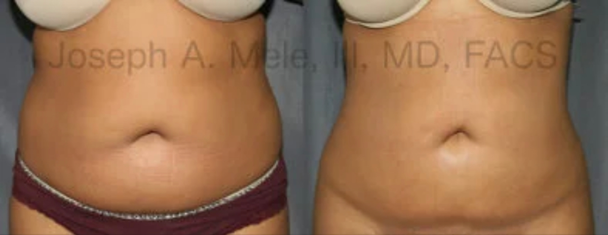 Liposuction of Back and Flanks - Associates in Plastic Surgery