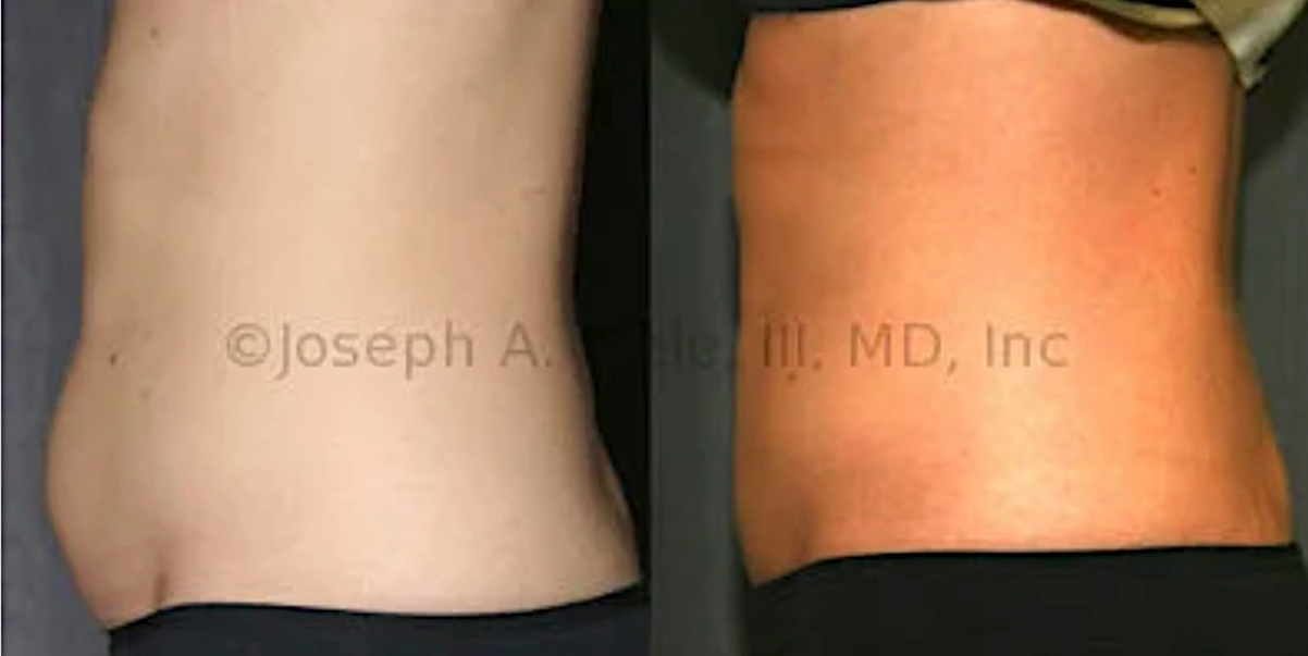 Lipo 360 before and after pictures - liposuction