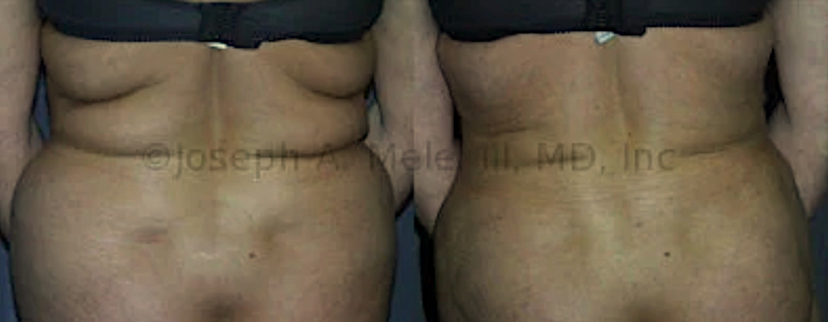 Lipo 360 before and after pictures - liposuction