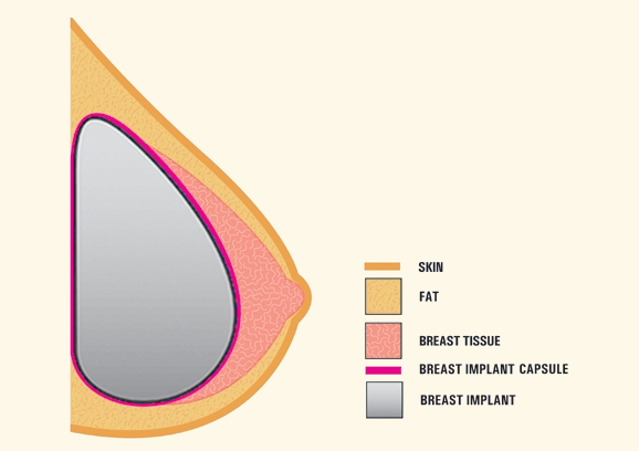 Breast Implant Capsule Diagram