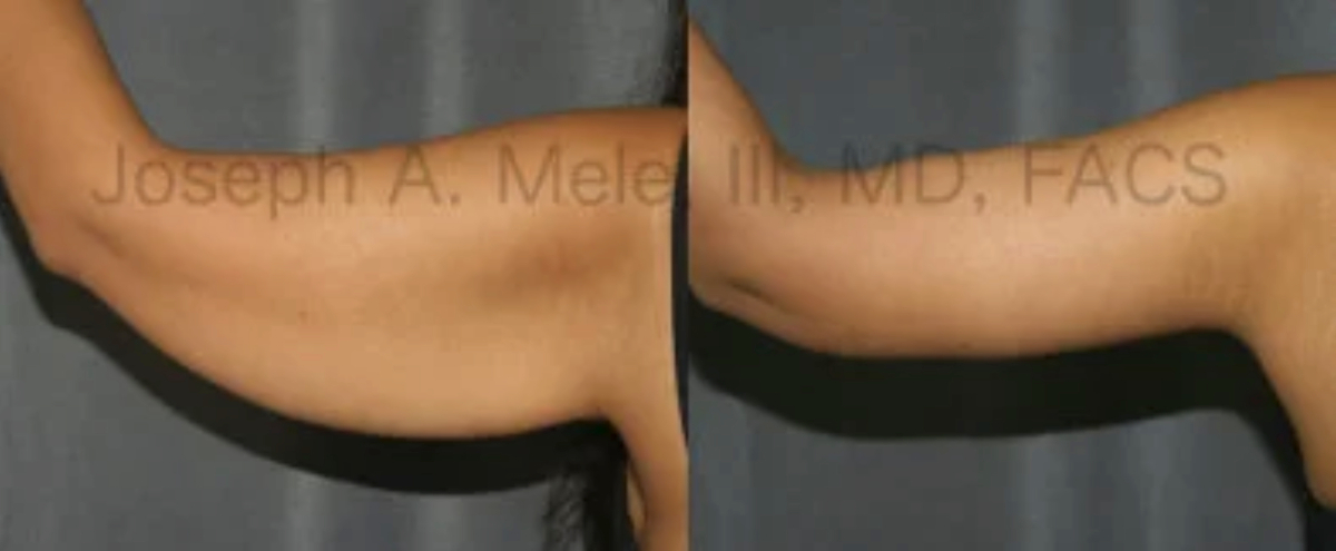 Arm Lift Before and After Photos