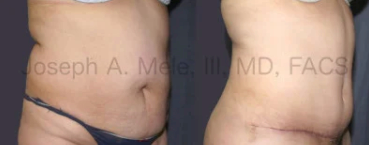 Tummy Tuck Before and After pictures