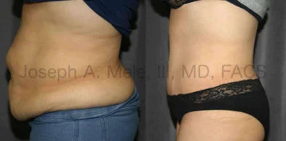 Tummy Tuck Before and After pictures