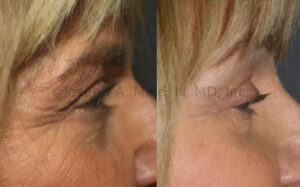 Blepharoplasty and Chemical Peel before and after pictures