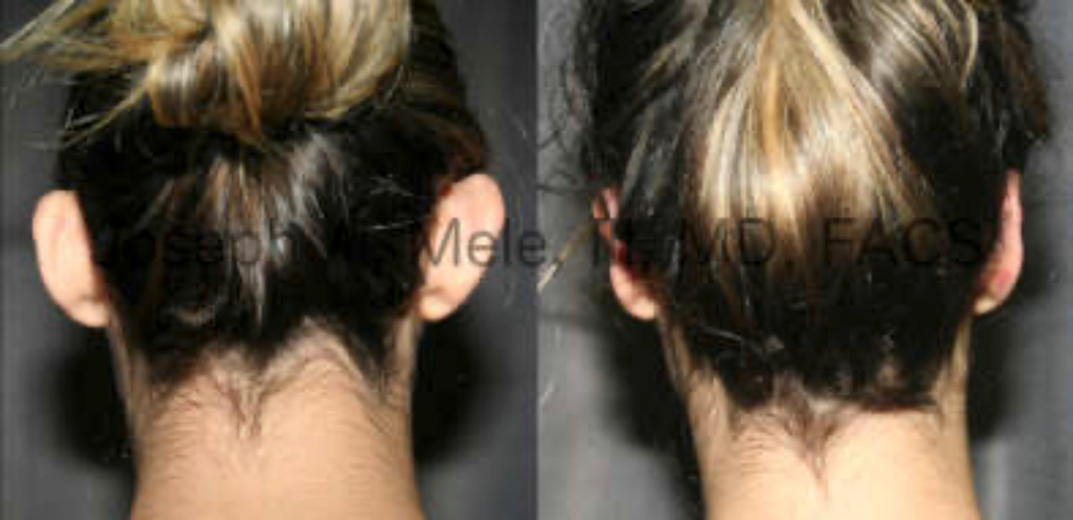 Otoplasty Before and After Pictures Ear Pinning