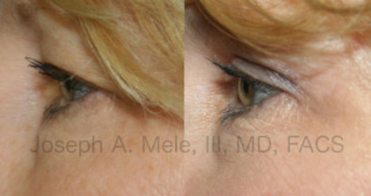 Blepharoplasty before and after pictures Eyelids