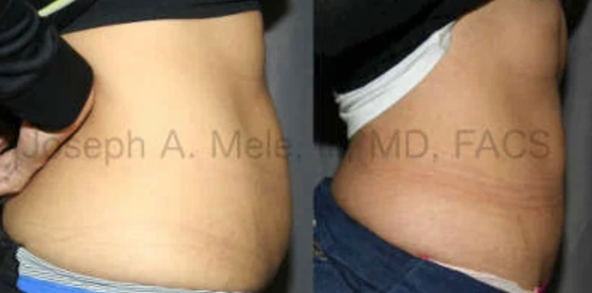 Liposuction Before and After pictures - lateral abdominal view (censored).