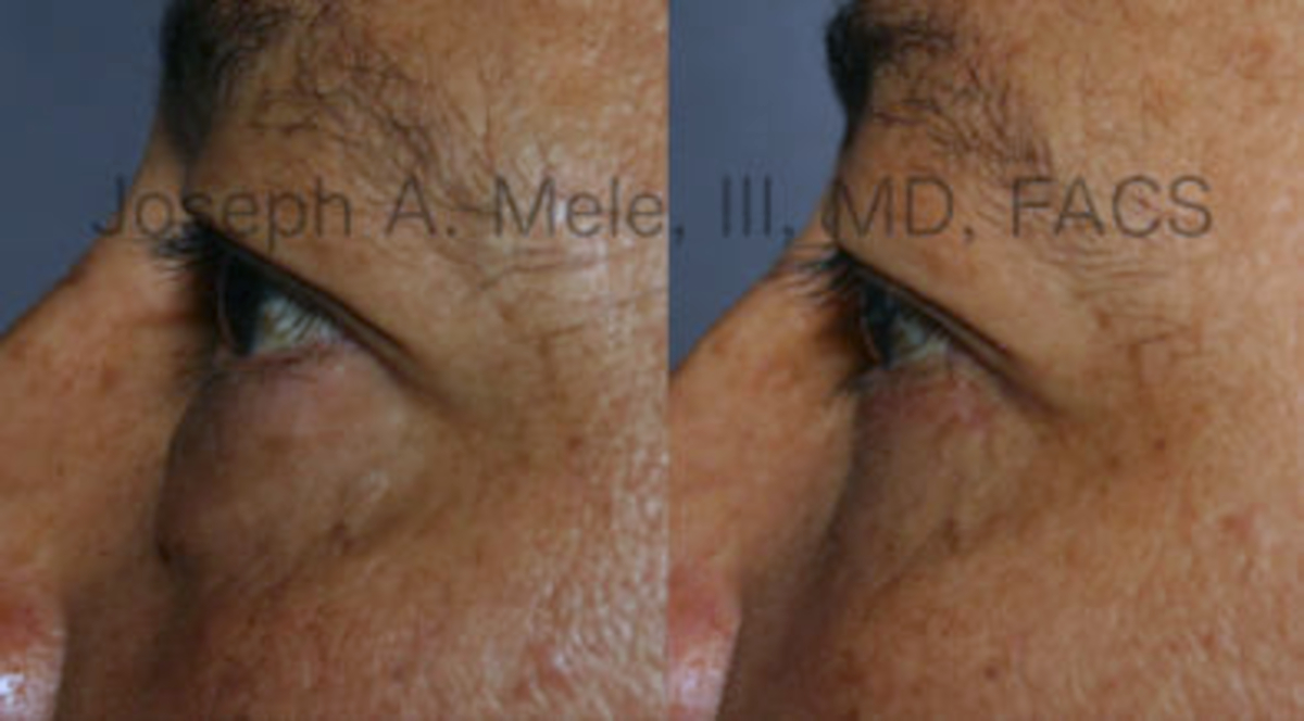 Lower Eyelid Surgery before and after pictures blepharoplasty