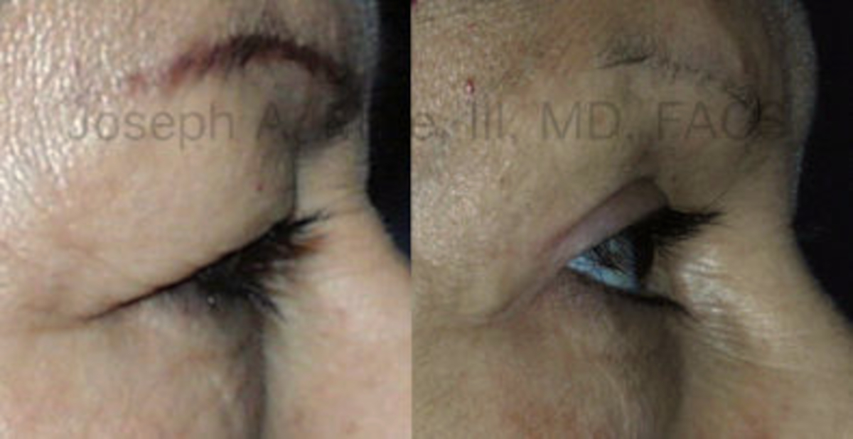 Upper Eyelid Surgery before and after pictures blepharoplasty