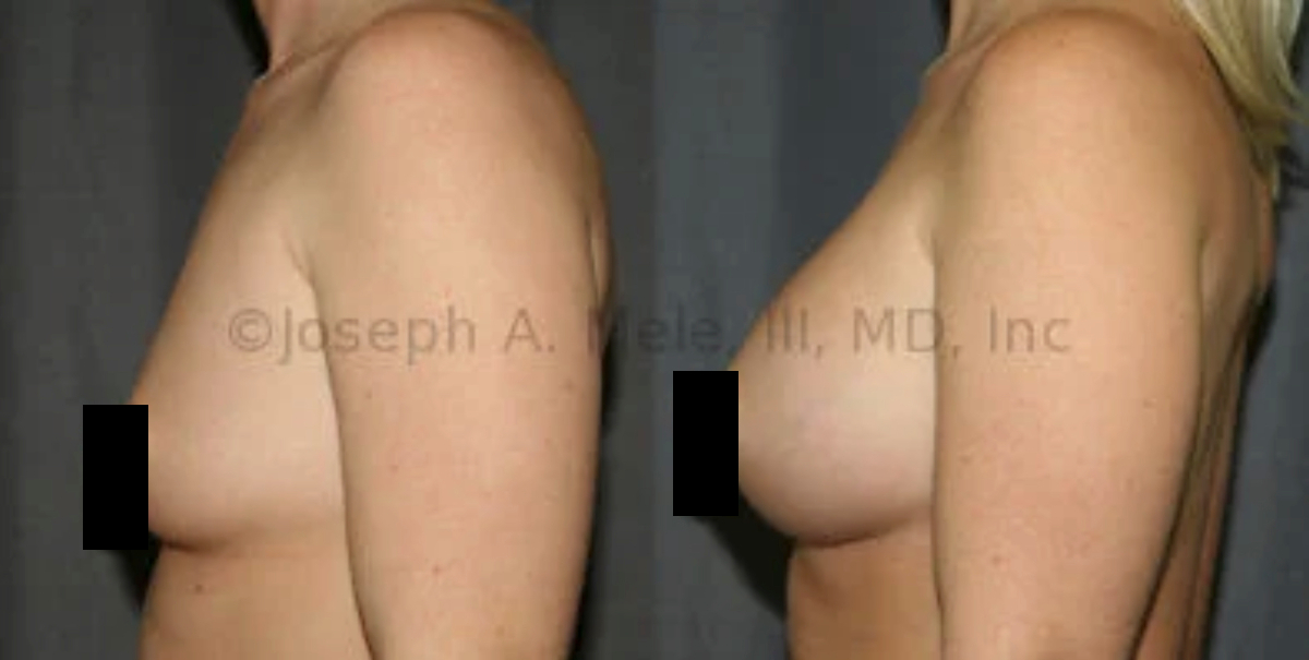 Breast Augmentation Before and After