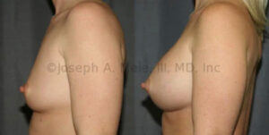 Breast Augmentation Before and After