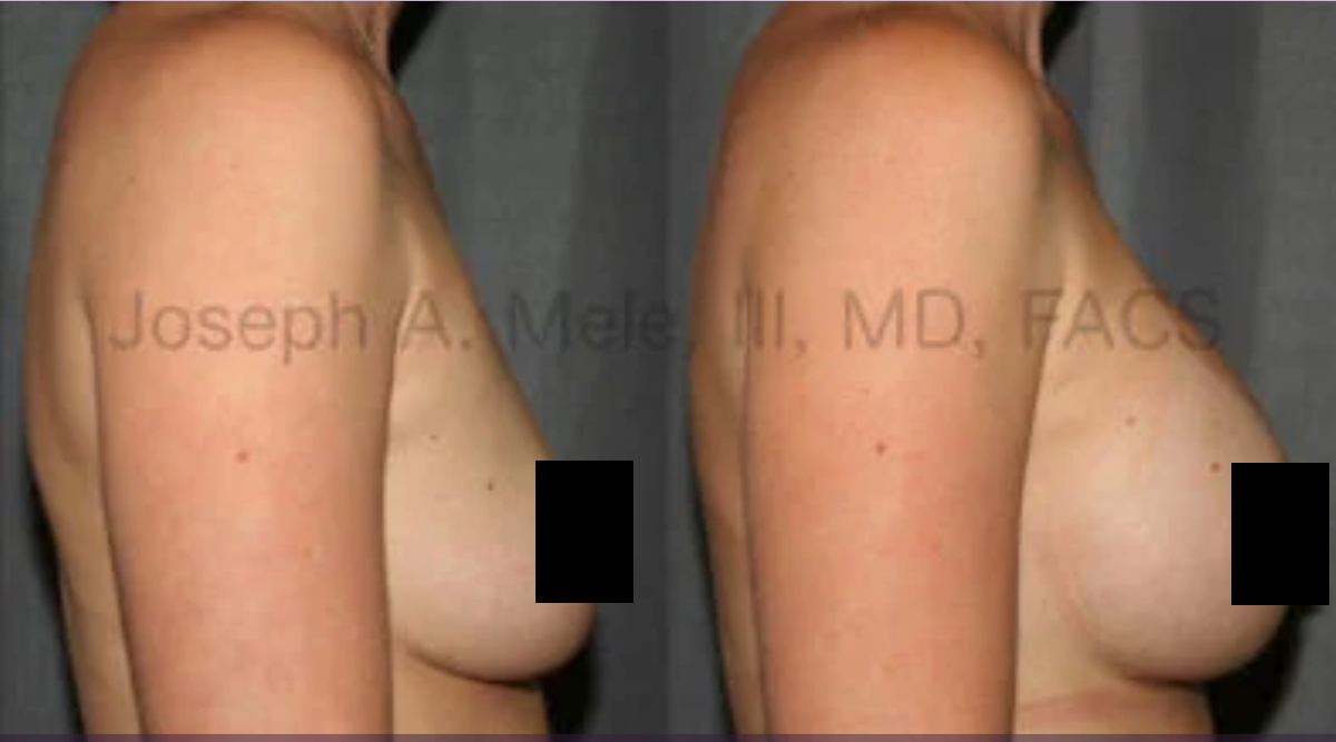 Breast Enlargement Before and After Pictures