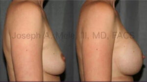 Breast Enlargement Before and After Pictures