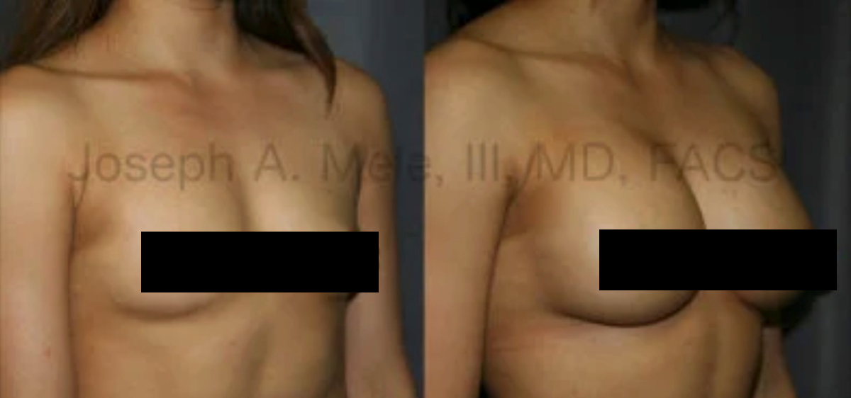 Breast Implant Before and After Pictures