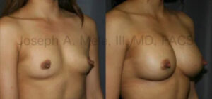 Breast Implant Before and After Pictures