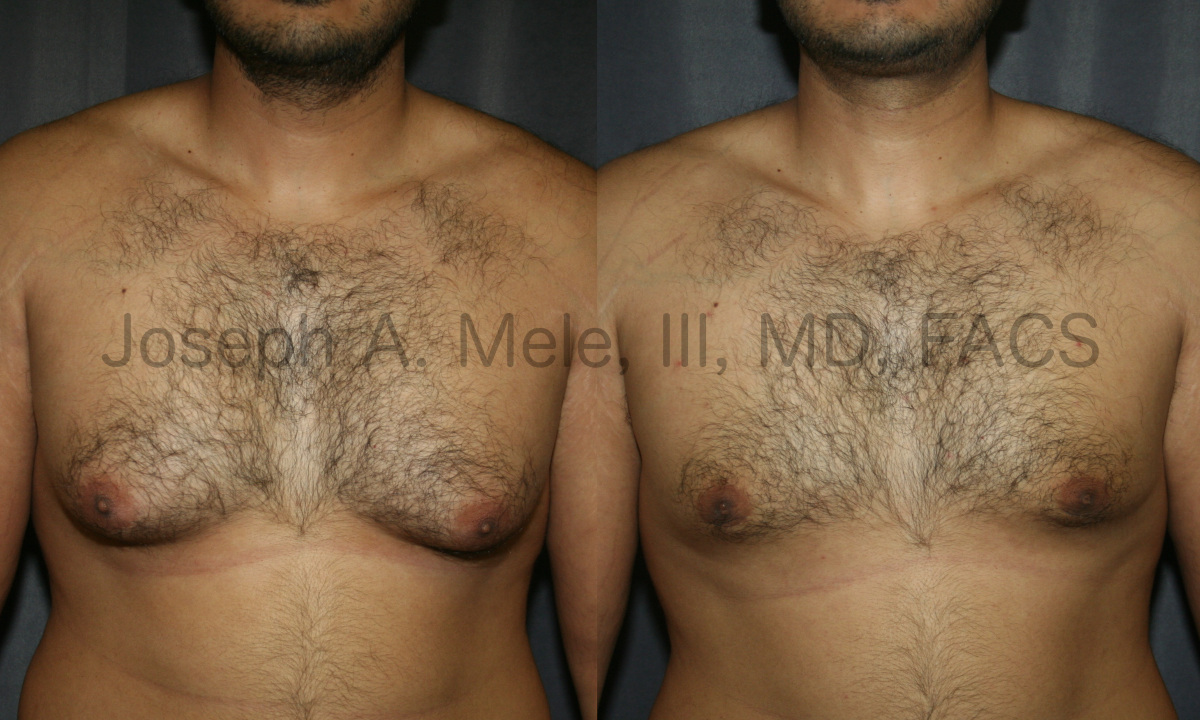 Gynecomastia Reduction (Male Breast Reduction) Before and After Photos