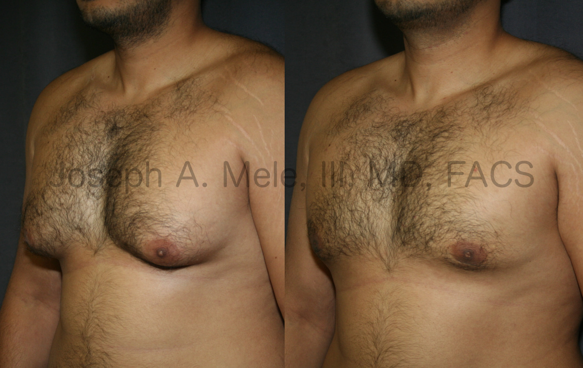 Gynecomastia Reduction (Male Breast Reduction) Before and After Photos