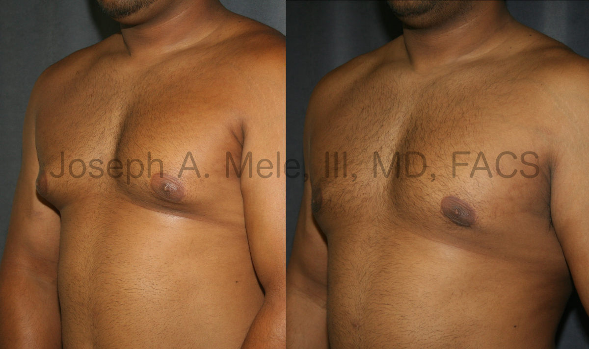 Gynecomastia Reduction (Male Breast Reduction) Before and After Photos