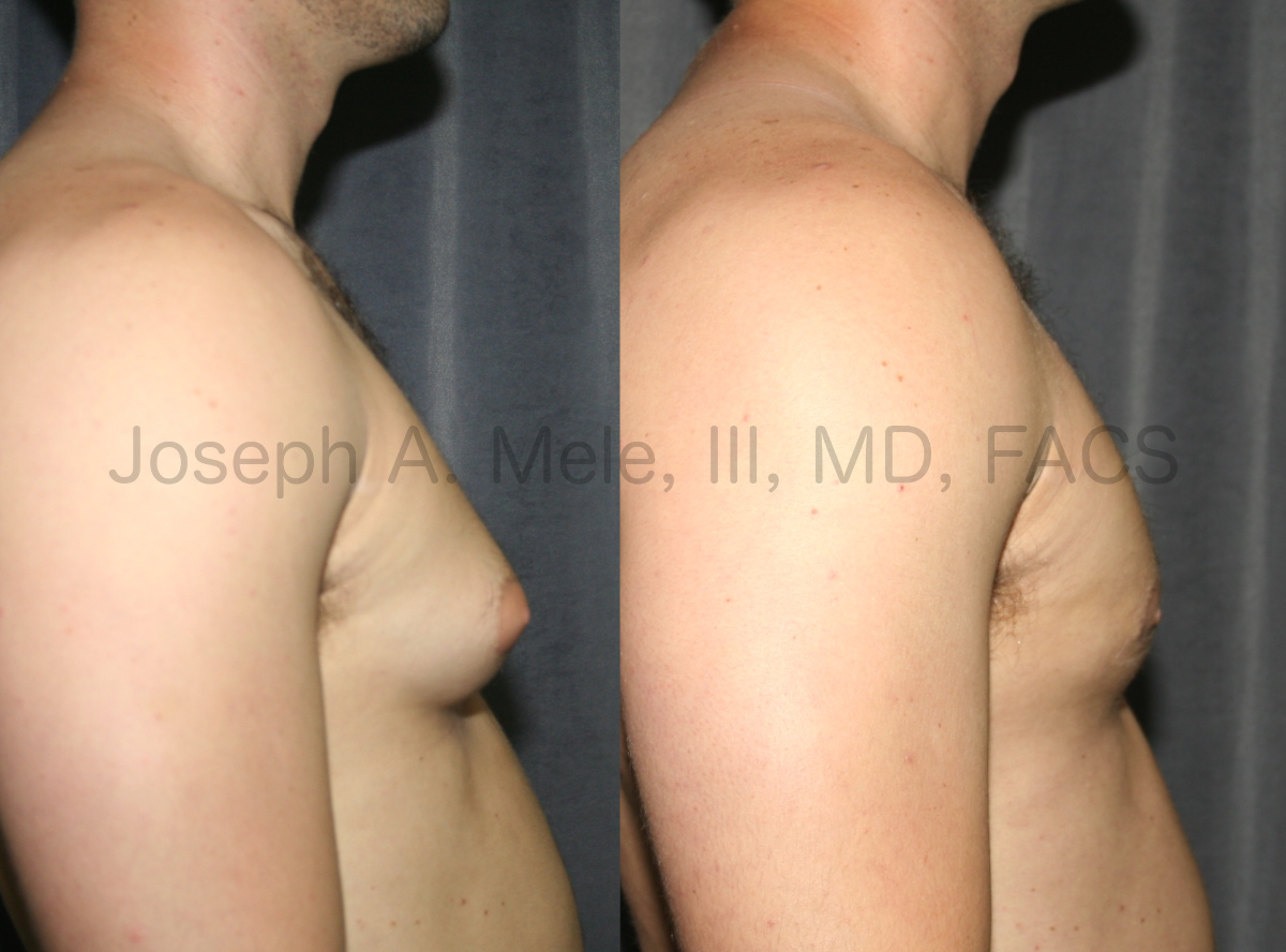 Gynecomastia Reduction (Male Breast Reduction) Before and After Photos